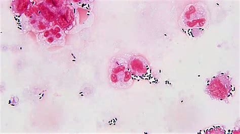streptococcus pneumoniae pathology