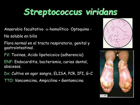 streptococcus viridans enfermedades