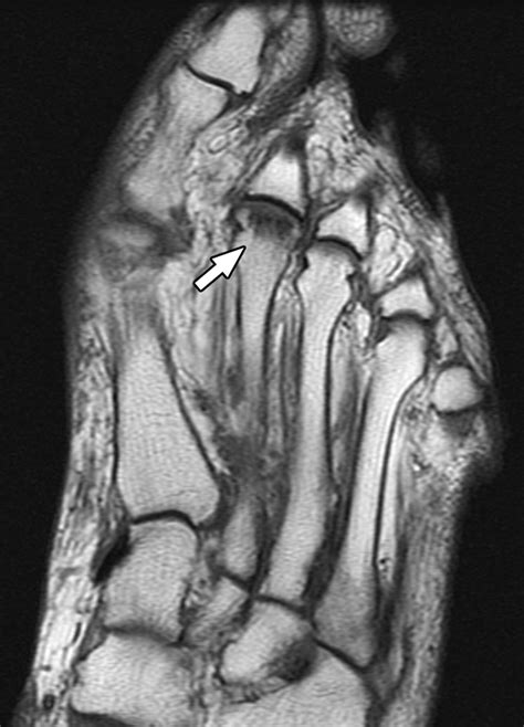 stress fracture 2nd metatarsal mri