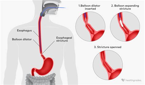 Stretch Esophagus During Endoscopy