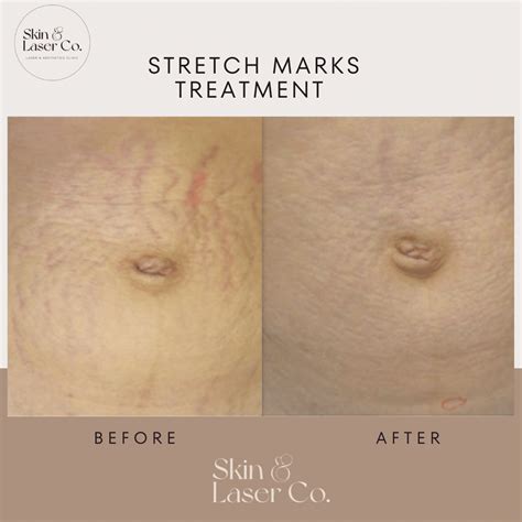 Bawang Merah Menyamarkan Stretch Mark
