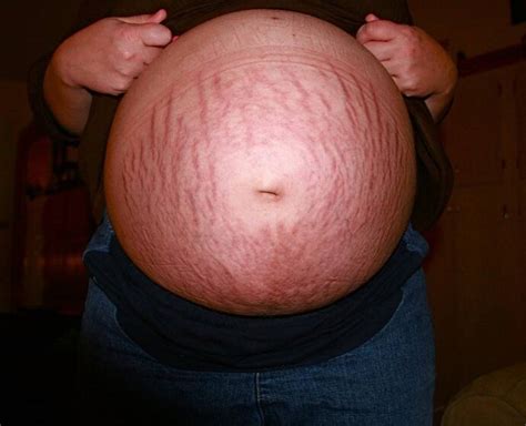Stretch Mark pada Ibu Hamil