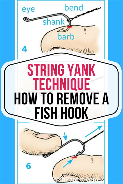 String Hook Removal