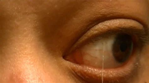 Strings Eye Disease