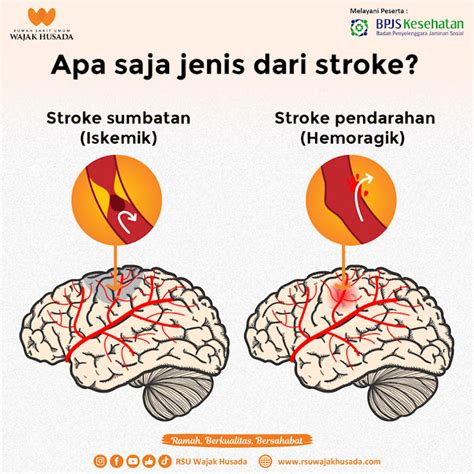 Infografis Stroke Cegah Stroke Sejak Dini House of Infographics