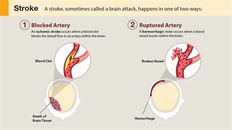 Understanding the Stroke Medical Term: Causes, Symptoms, and Treatment Options