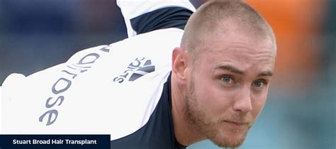 stuart broad hair transplant