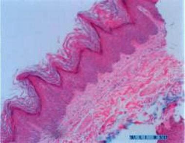 stucco keratosis pathology