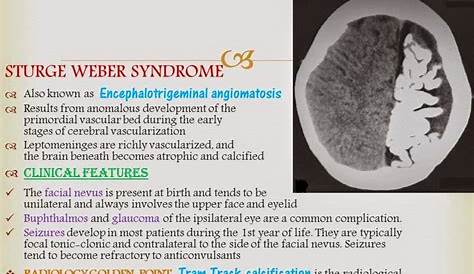 Sturge Weber Syndrome Radiology Image