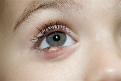 sty in eye treatment for kids