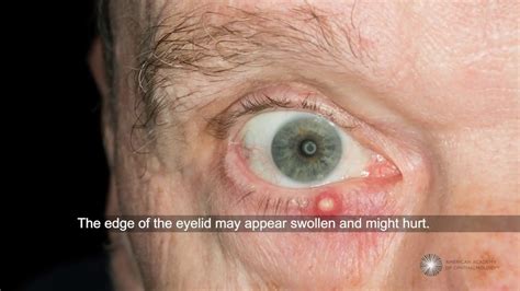 Stye Eyelid Pop