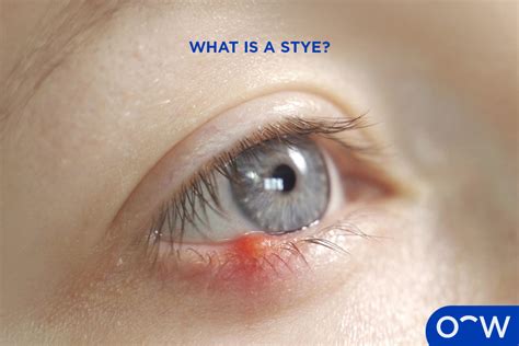 Understanding and Treating a Stye on Eyeball: Causes, Symptoms, and Effective Remedies