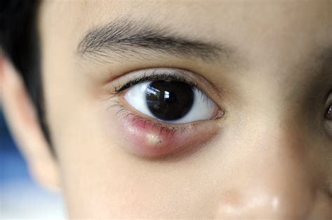 stye on eyelid medical term