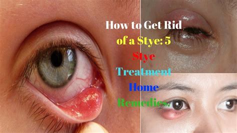 stye on eyelid treatment antibiotics