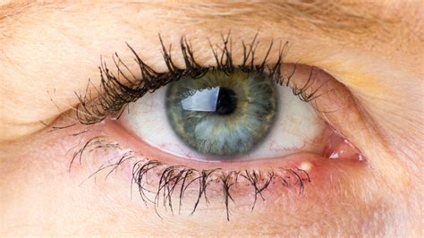 Understanding and Treating a Stye on the Eye: Causes, Symptoms, and Effective Remedies