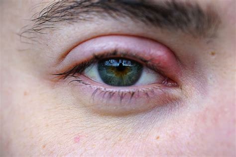 stye symptoms eye