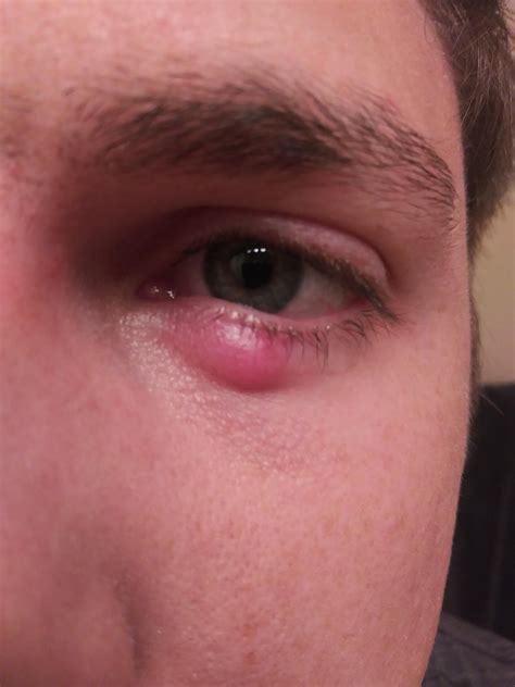 stye that won't go away for months