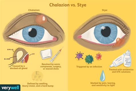 stye vs chalazion cartoon