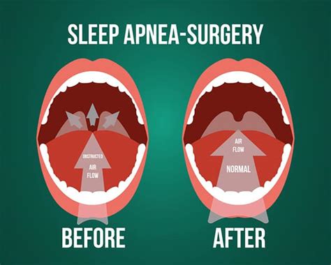 success rate of sleep apnea surgery