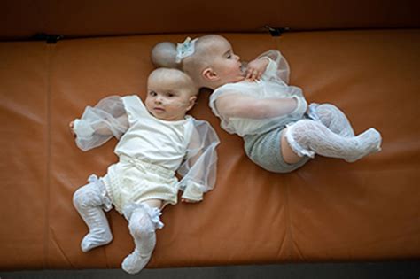 successful conjoined twins separated stories