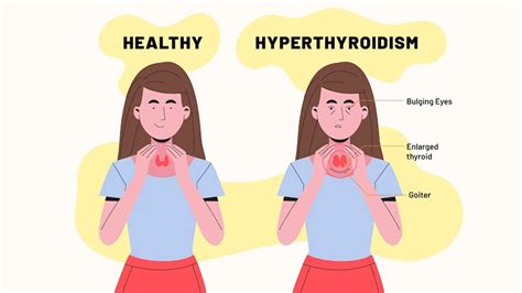 sudo sudo hyperthyroidism