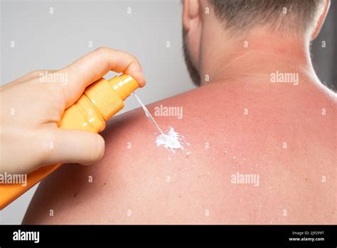 Protect Your Skin: The Ultimate Guide to Preventing Sunburn and Choosing the Right Sunscreen