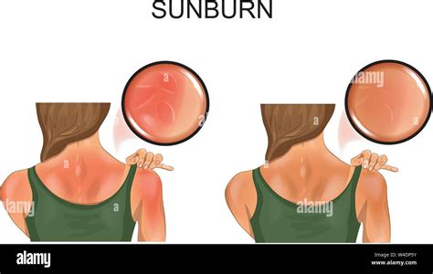 Sunburn Vs Tan Difference