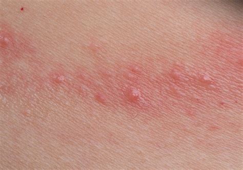 sunscreen contact dermatitis treatment