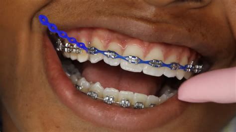 Super Chain Braces