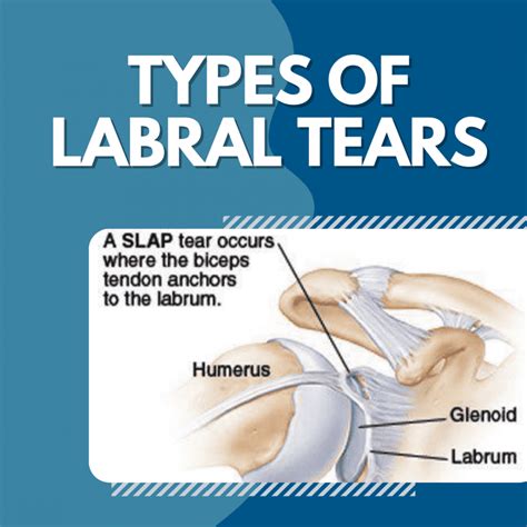 superior glenoid labral tear