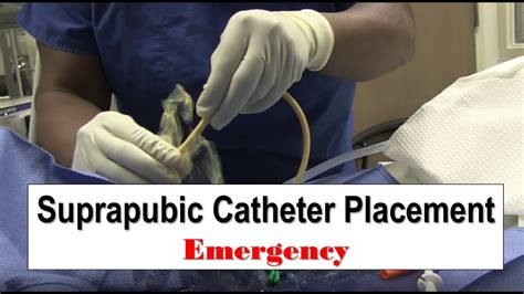 suprapubic catheter nursing care plan