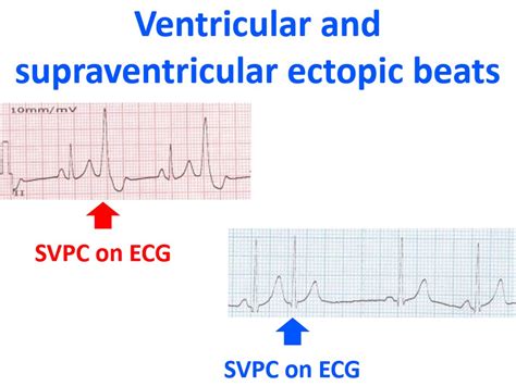 supraventricular ectopic heartbeat