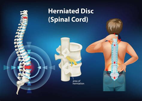 Surfing Herniated Disc