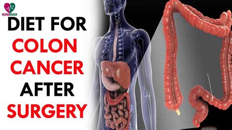 surgery for colon cancer removal recovery