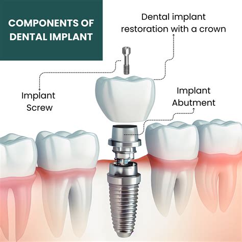 Transform Your Smile: Understanding the Surgery for Dental Implants Process