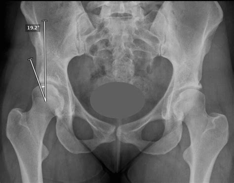 surgery for hip dysplasia in adults