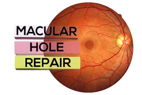 surgery for macular hole