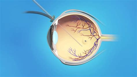 surgery for macular hole repair