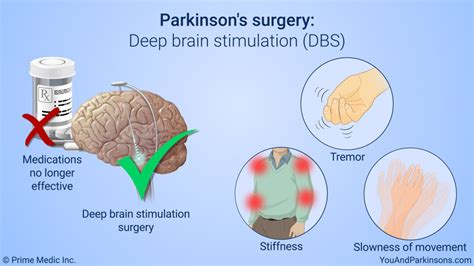 surgery for parkinson's disease treatment