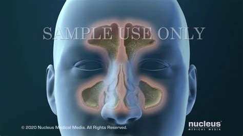 Effective Surgery for Sinus Infections: A Lifesaving Solution