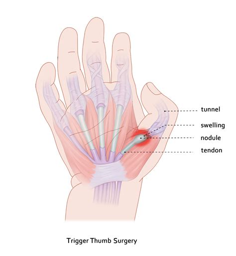 Effective Surgery for Trigger Thumb: Relieve Pain Quickly