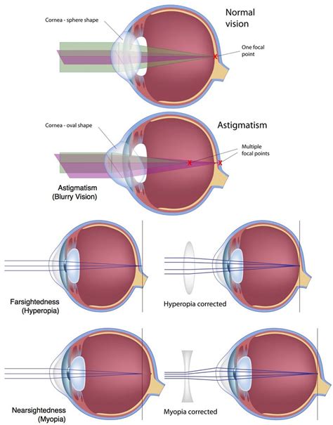 surgery to correct eyesight