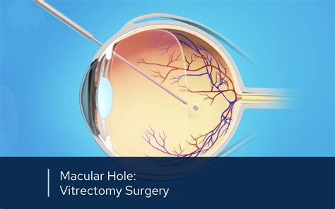 surgery to fix macular hole