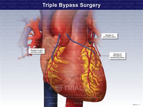 Understanding Surgery Triple Bypass: What You Need to Know
