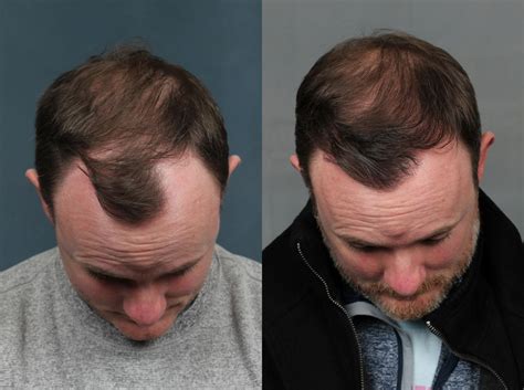 Before and After Hair Restoration showing the top of man's head