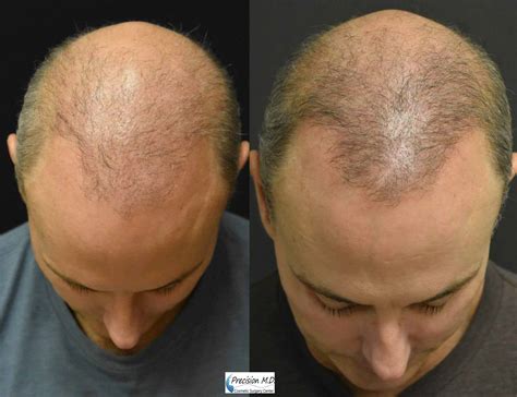 Before and After Hair Restoration showing the top of man's head