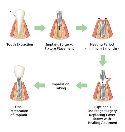 Surgical Procedures For Dental Implants