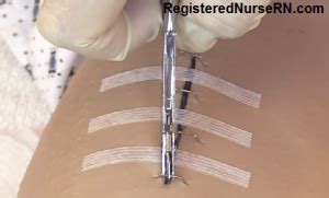 Surgical Staples Removal Pain