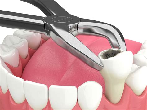 Surgical Tooth Extraction Swelling