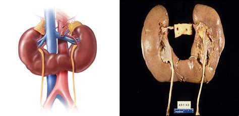 surgical treatment of the horseshoe kidney